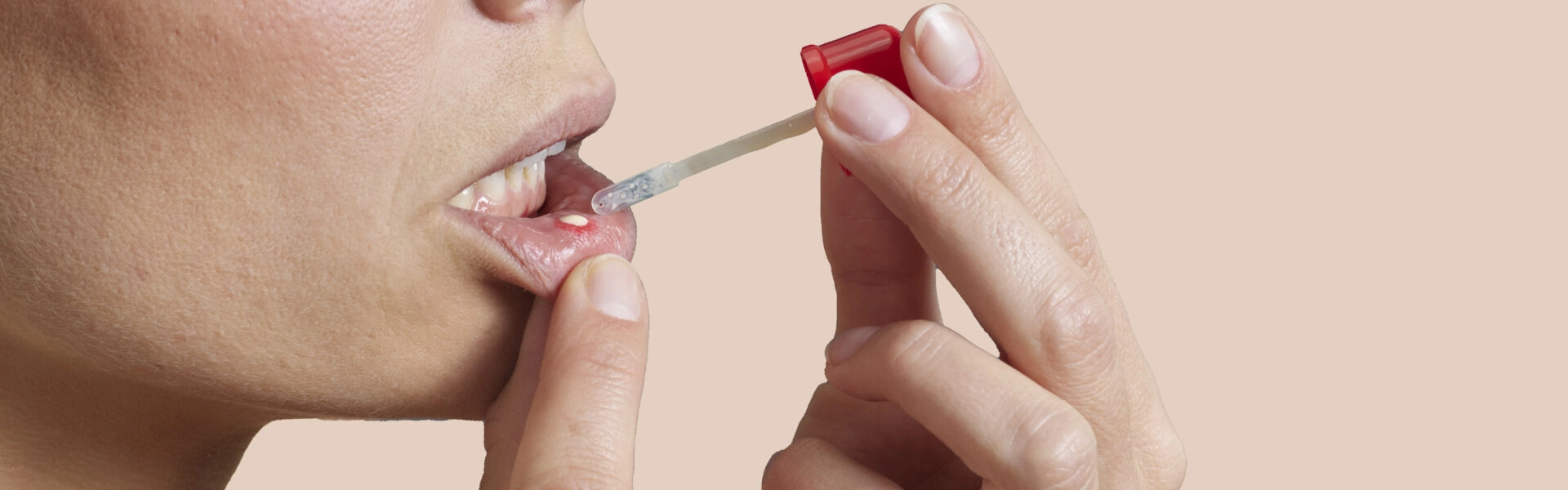 How to prevent and treat a mouth ulcer?