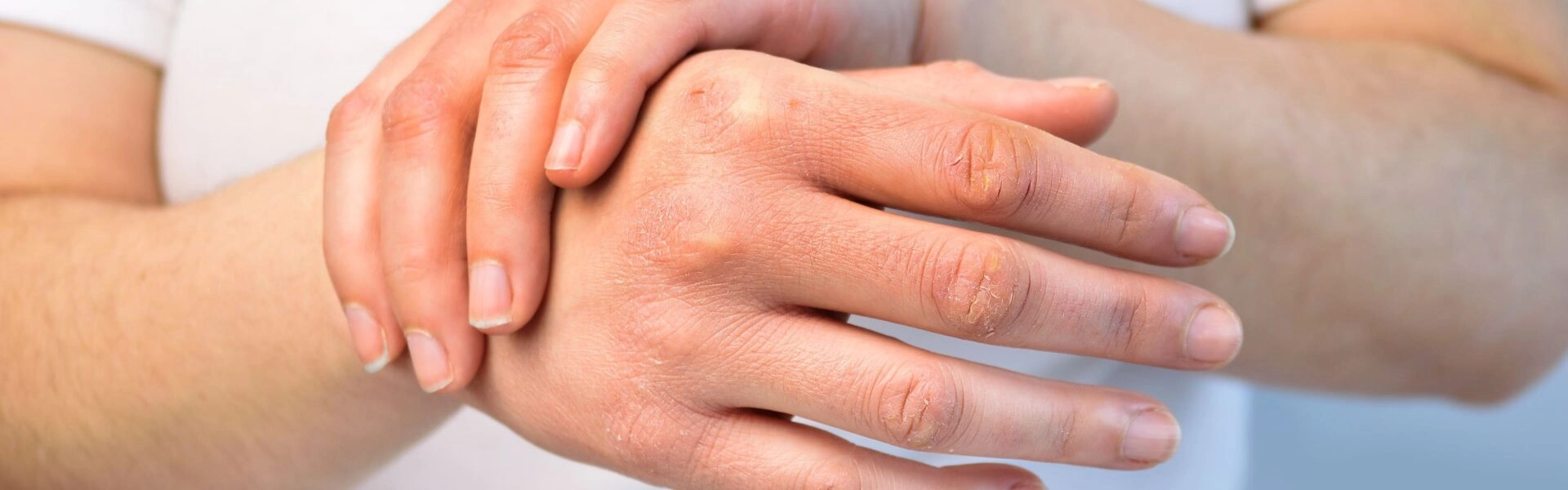 How to prevent and treat cracks in hands and feet?