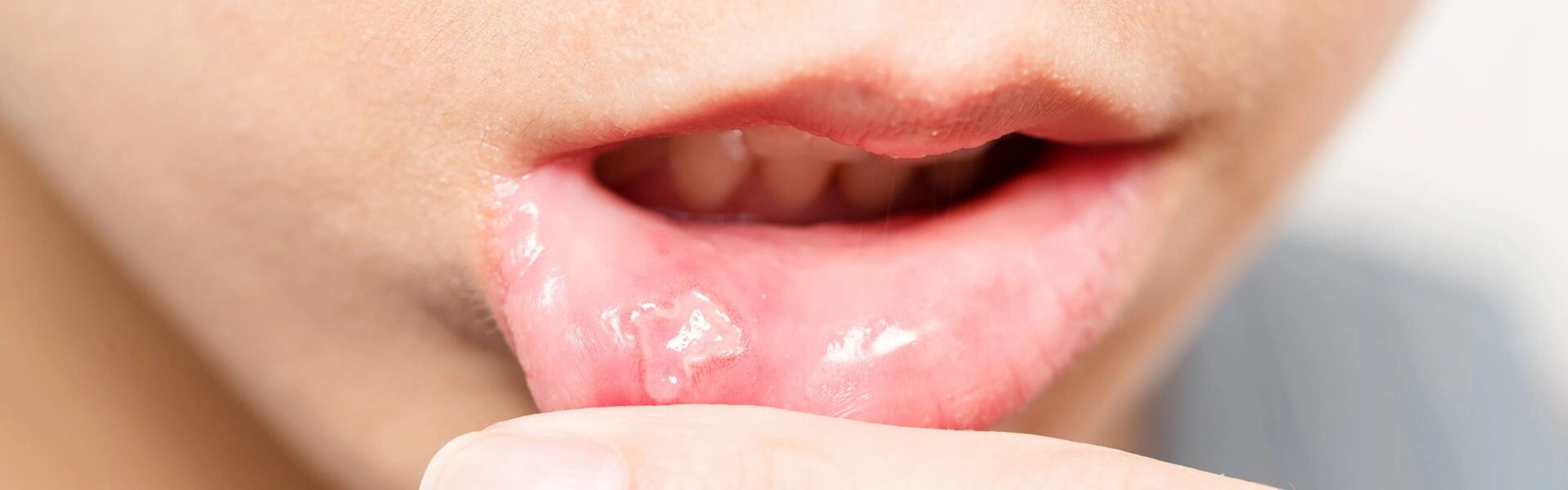 Understanding mouth ulcers better