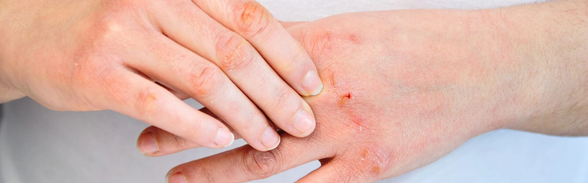 What causes cracks in hands and feet?