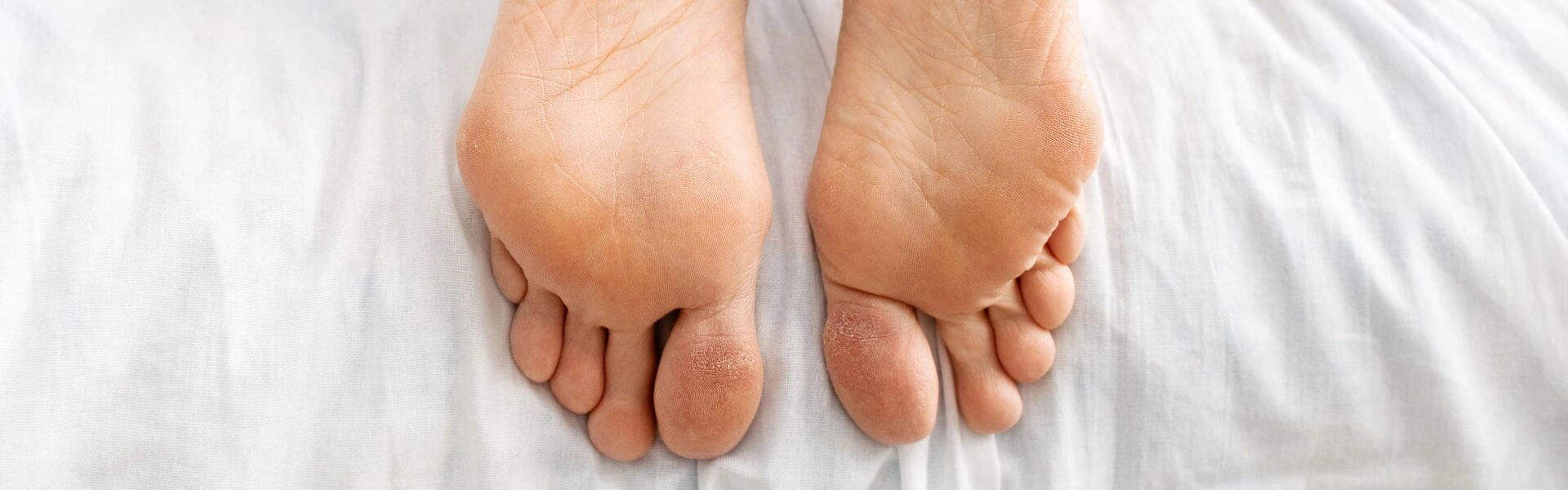 Cracked heels: how to treat damaged feet?