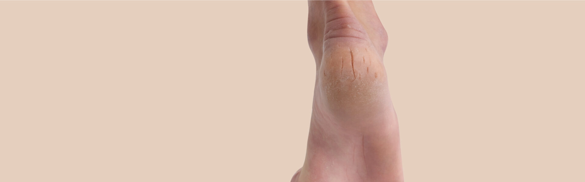 Very dry, cracked feet: what to do?