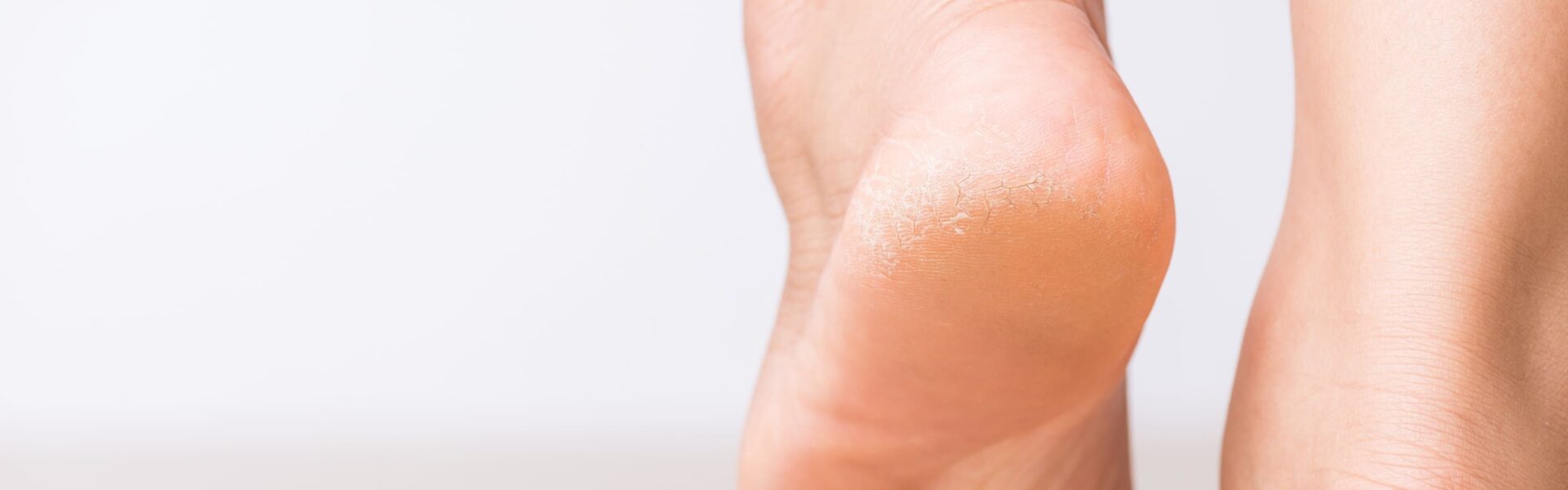 What causes very dry feet ?