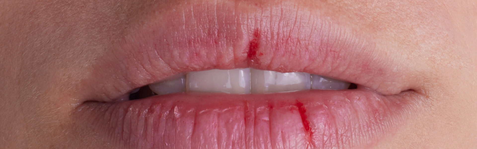 Damaged or cracked lips: how to prevent and repair them effectively?